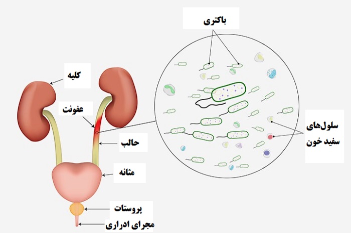 عفونت ادراری در مردان و افزایش خطر ابتلا به بی اختیاری ادرار - کلینیک توانبخشی بی اختیاری ادرار امید